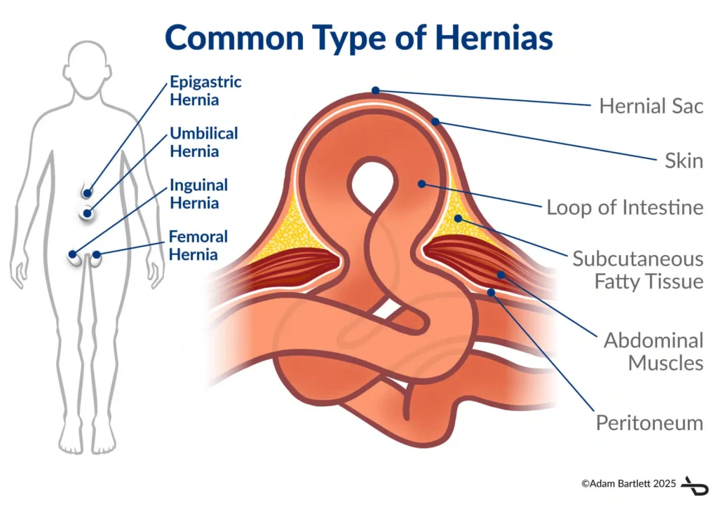 Epigastric Hernia Symptoms Diagnosis Treatment Epigastric Hernia Symptoms Diagnosis Treatment